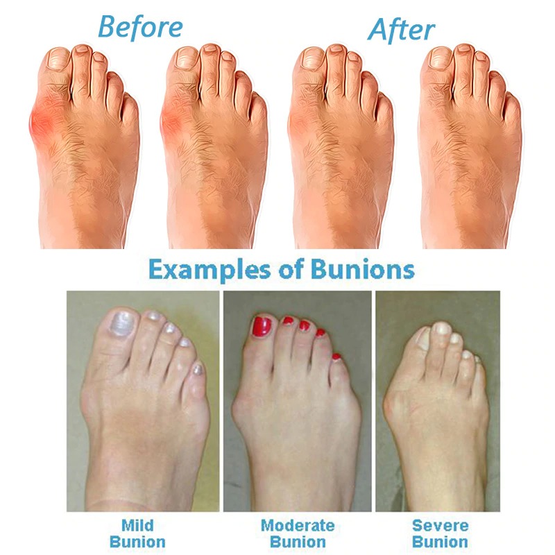 Bunion Correction Sandal For Women